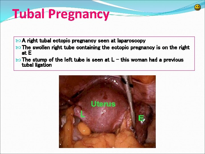 Tubal Pregnancy A right tubal ectopic pregnancy seen at laparoscopy The swollen right tube