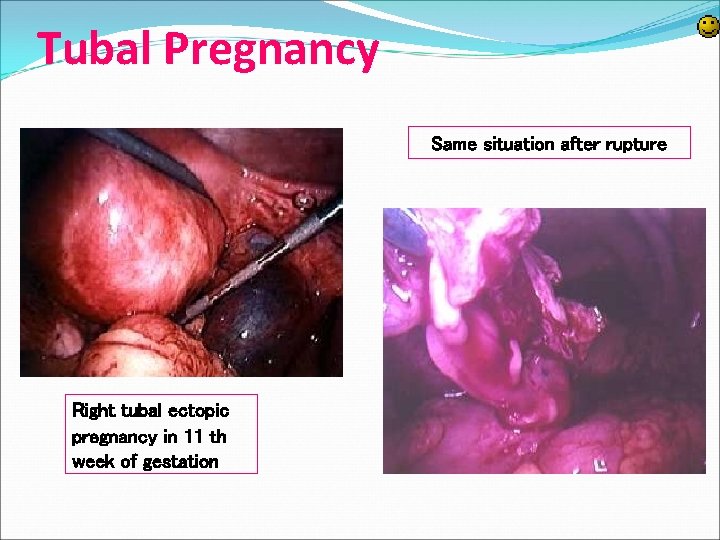 Tubal Pregnancy Same situation after rupture Right tubal ectopic pregnancy in 11 th week