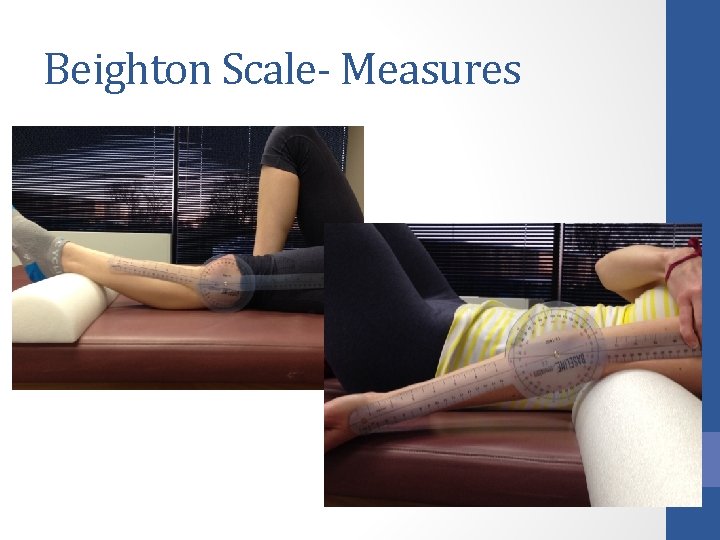 Beighton Scale- Measures 