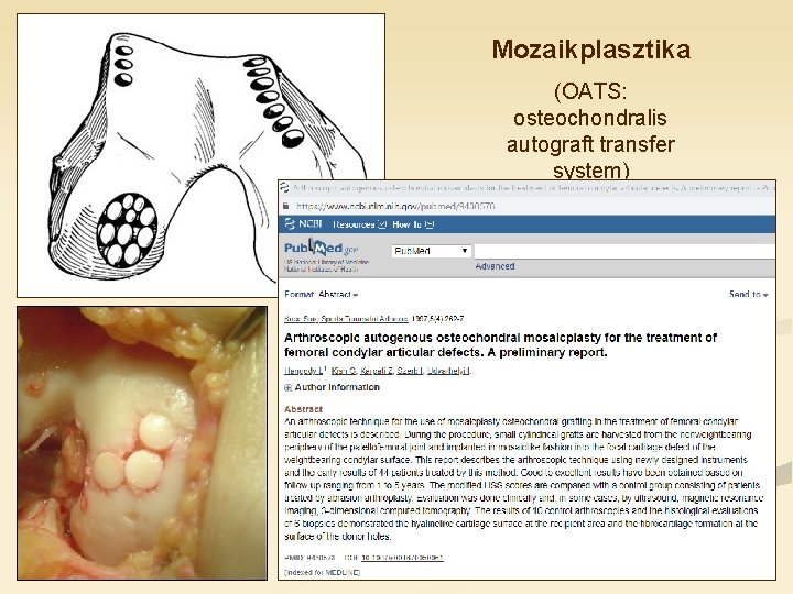 Mozaikplasztika (OATS: osteochondralis autograft transfer system) 