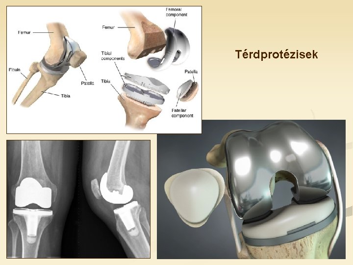 Térdprotézisek 