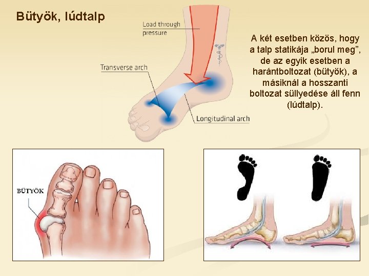 Bütyök, lúdtalp A két esetben közös, hogy a talp statikája „borul meg”, de az