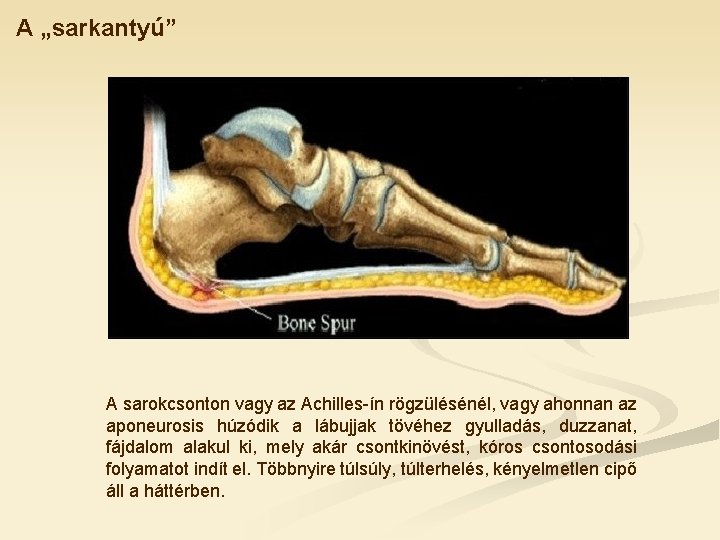 A „sarkantyú” A sarokcsonton vagy az Achilles-ín rögzülésénél, vagy ahonnan az aponeurosis húzódik a