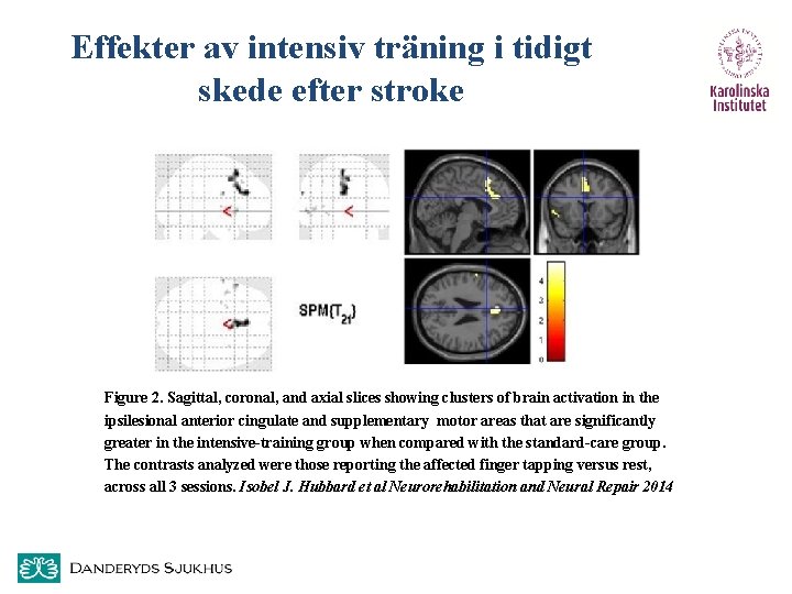 Effekter av intensiv träning i tidigt skede efter stroke Figure 2. Sagittal, coronal, and