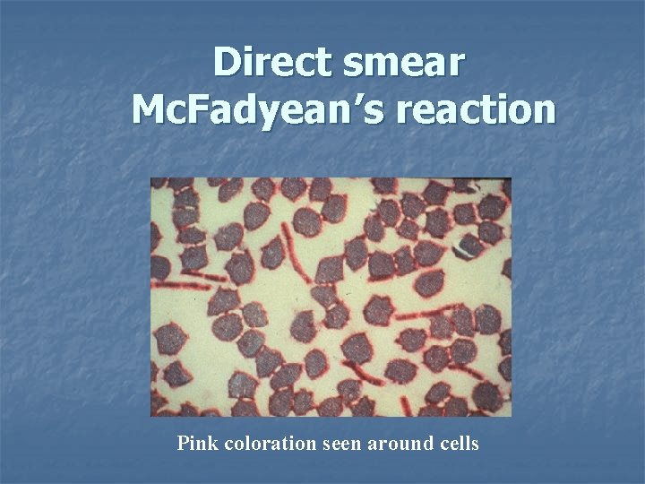 Direct smear Mc. Fadyean’s reaction Pink coloration seen around cells 