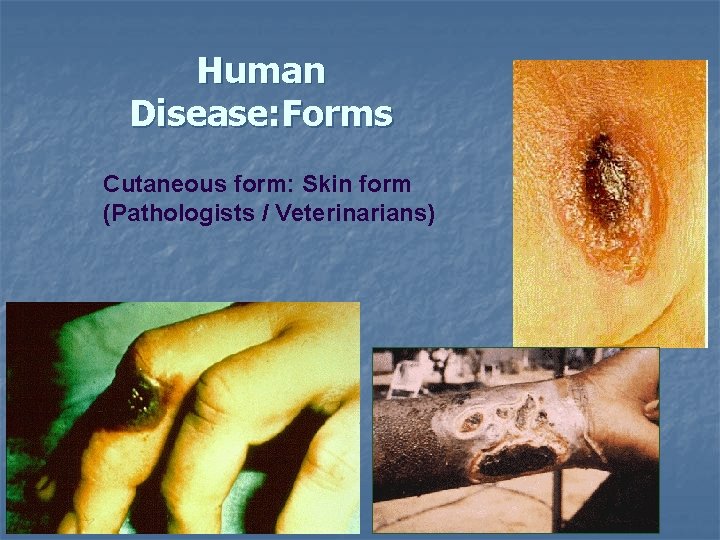 Human Disease: Forms Cutaneous form: Skin form (Pathologists / Veterinarians) 