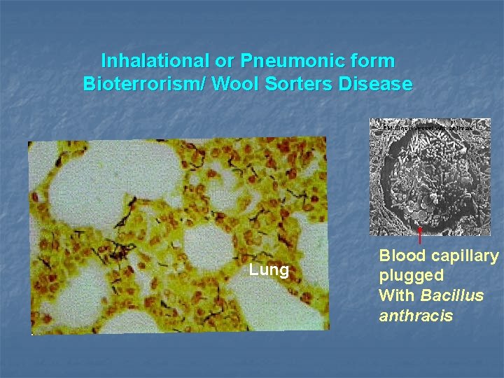 Inhalational or Pneumonic form Bioterrorism/ Wool Sorters Disease EM: Blood vessel with anthrax Lung