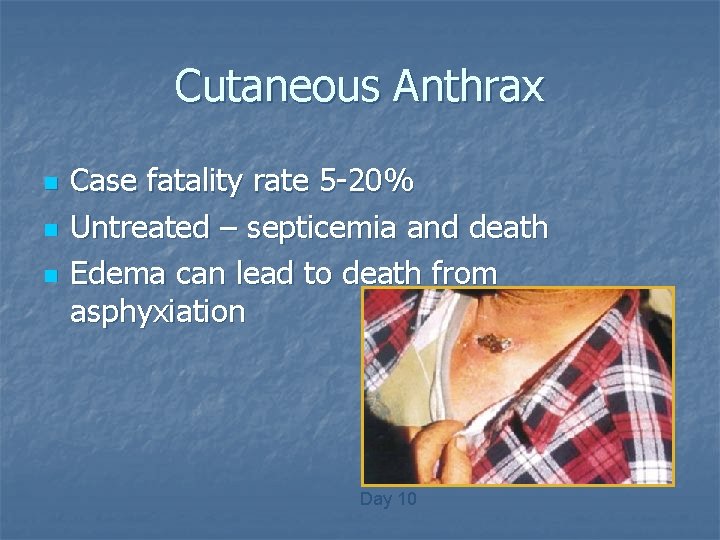 Cutaneous Anthrax n n n Case fatality rate 5 -20% Untreated – septicemia and