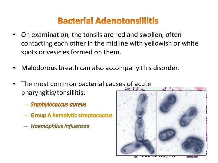  • On examination, the tonsils are red and swollen, often contacting each other