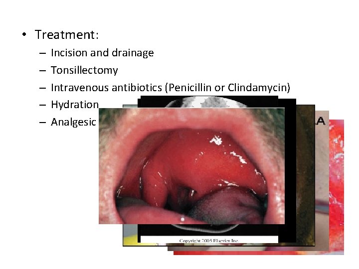  • Treatment: – – – Incision and drainage Tonsillectomy Intravenous antibiotics (Penicillin or