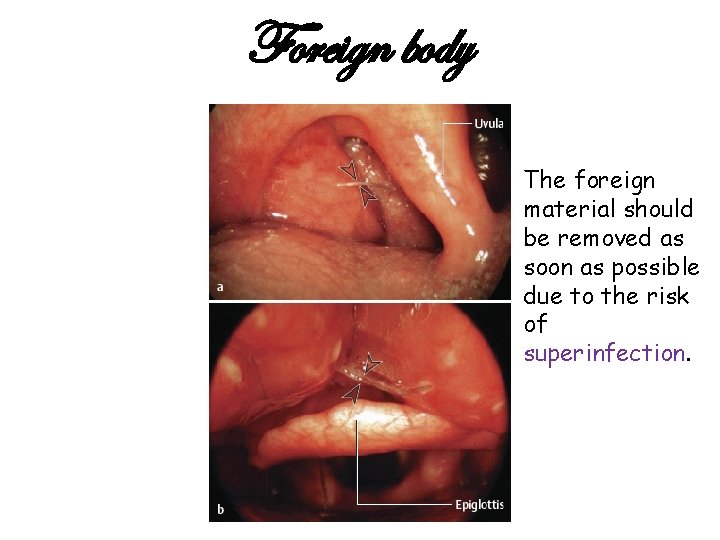 Foreign body The foreign material should be removed as soon as possible due to