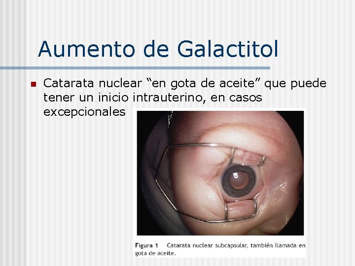 Aumento de Galactitol n Catarata nuclear “en gota de aceite” que puede tener un