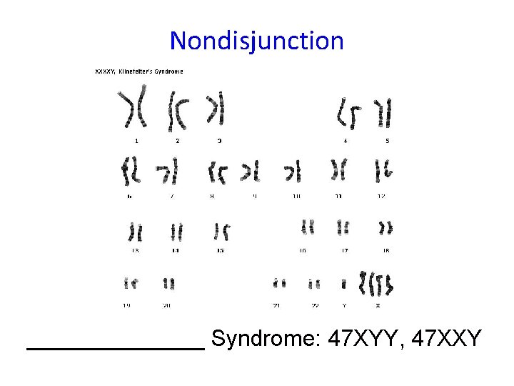 Nondisjunction _______ Syndrome: 47 XYY, 47 XXY 