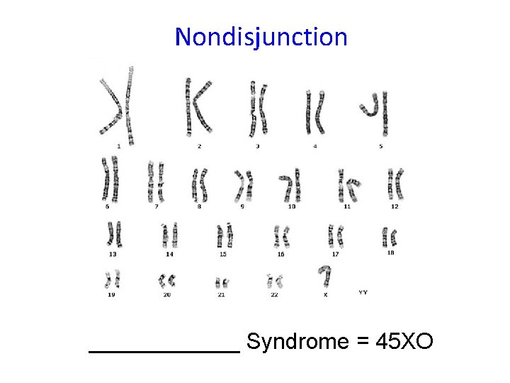 Nondisjunction ______ Syndrome = 45 XO 