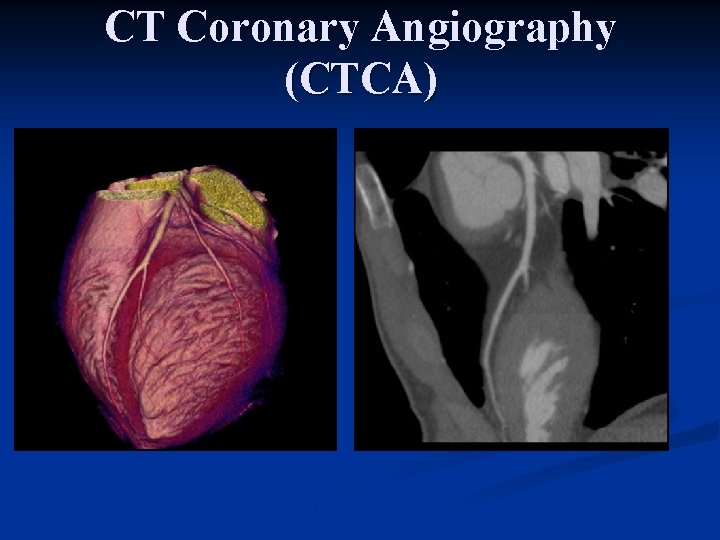 CT Coronary Angiography (CTCA) 12 th July 2016 – ECTC Audit Day 