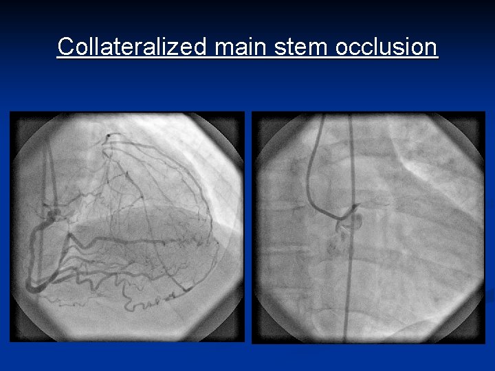 Collateralized main stem occlusion 