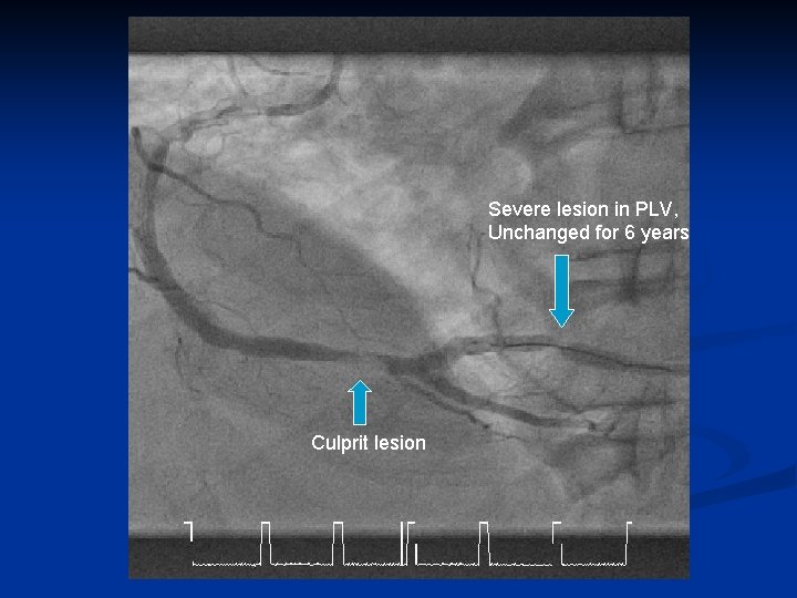 Severe lesion in PLV, Unchanged for 6 years Culprit lesion 