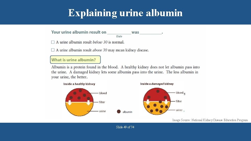 Explaining urine albumin Image Source: National Kidney Disease Education Program Slide 49 of 74