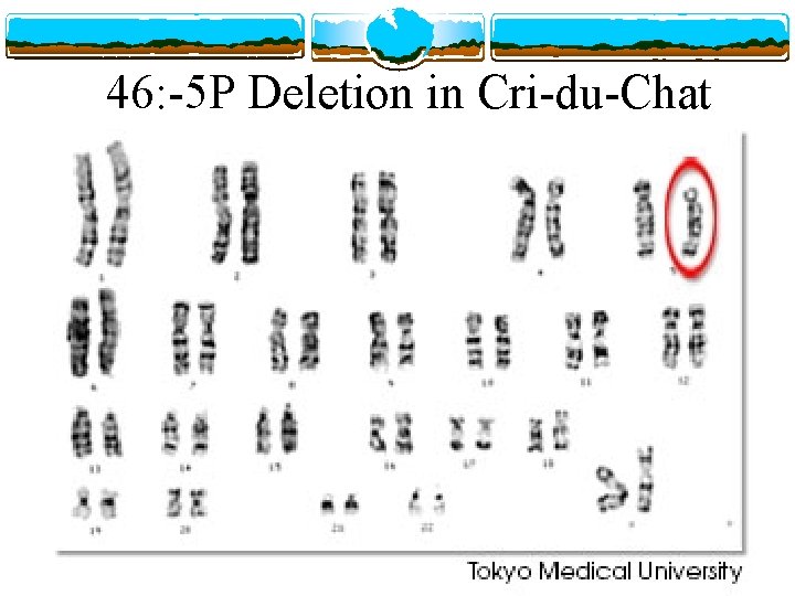46: -5 P Deletion in Cri-du-Chat 