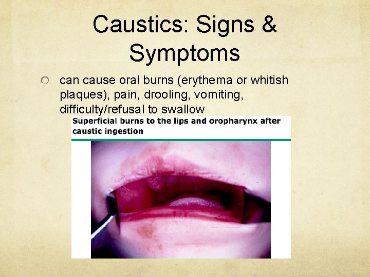 Caustics: Signs & Symptoms can cause oral burns (erythema or whitish plaques), pain, drooling,