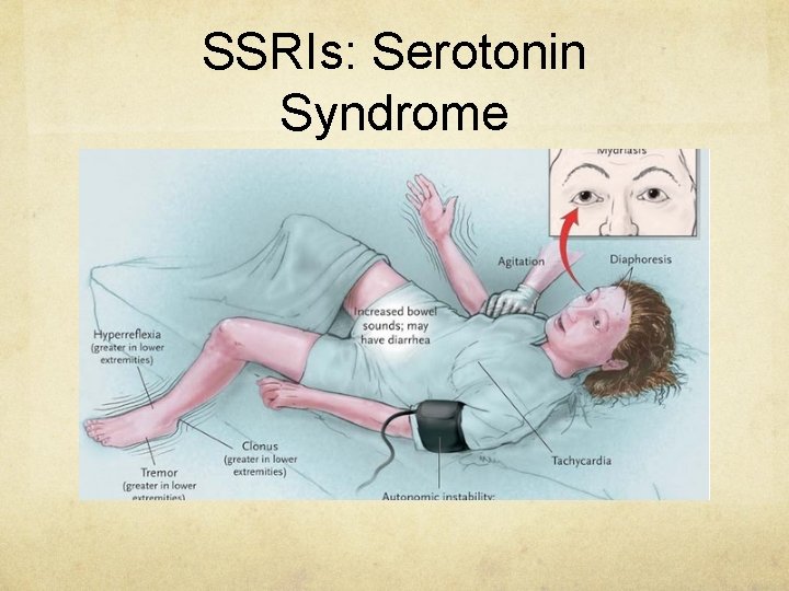 SSRIs: Serotonin Syndrome 