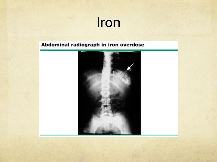 Iron 