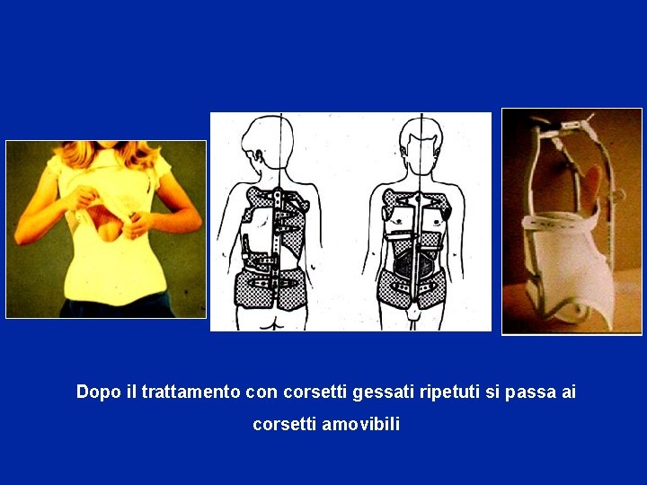 Dopo il trattamento con corsetti gessati ripetuti si passa ai corsetti amovibili 