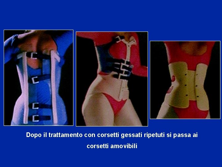 Dopo il trattamento con corsetti gessati ripetuti si passa ai corsetti amovibili 