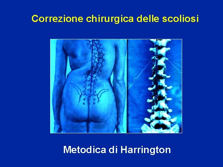 Correzione chirurgica delle scoliosi Metodica di Harrington 