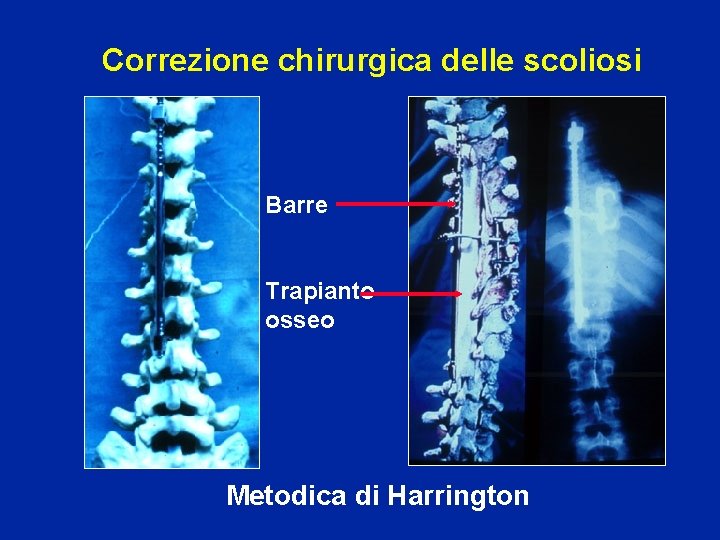 Correzione chirurgica delle scoliosi Barre Trapianto osseo Metodica di Harrington 