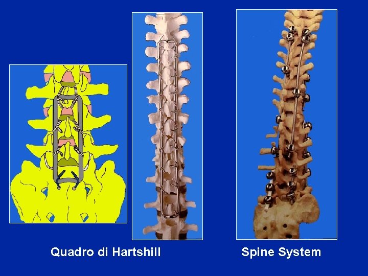  Quadro di Hartshill Spine System 