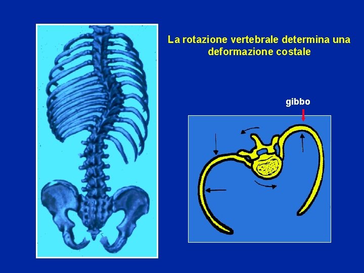 La rotazione vertebrale determina una deformazione costale gibbo 