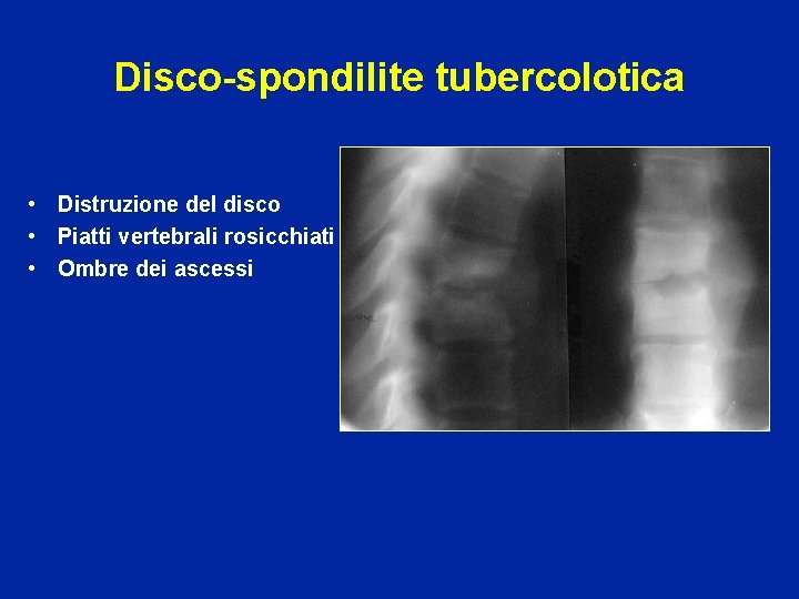 Disco-spondilite tubercolotica • Distruzione del disco • Piatti vertebrali rosicchiati • Ombre dei ascessi