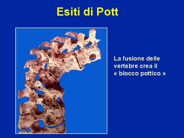 Esiti di Pott La fusione delle vertebre crea il « blocco pottico » 