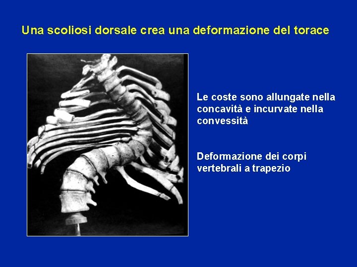 Una scoliosi dorsale crea una deformazione del torace Le coste sono allungate nella concavità