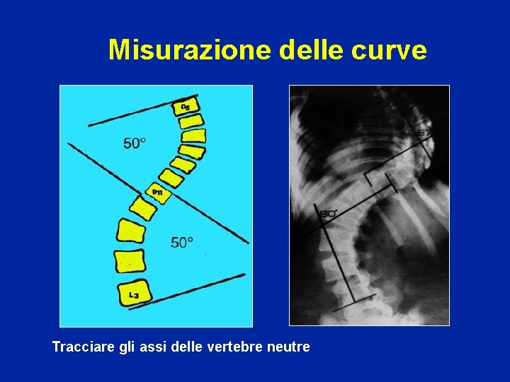 Misurazione delle curve Tracciare gli assi delle vertebre neutre 