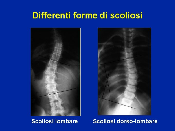 Differenti forme di scoliosi Scoliosi lombare Scoliosi dorso-lombare 