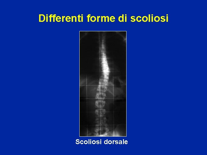 Differenti forme di scoliosi Scoliosi dorsale 