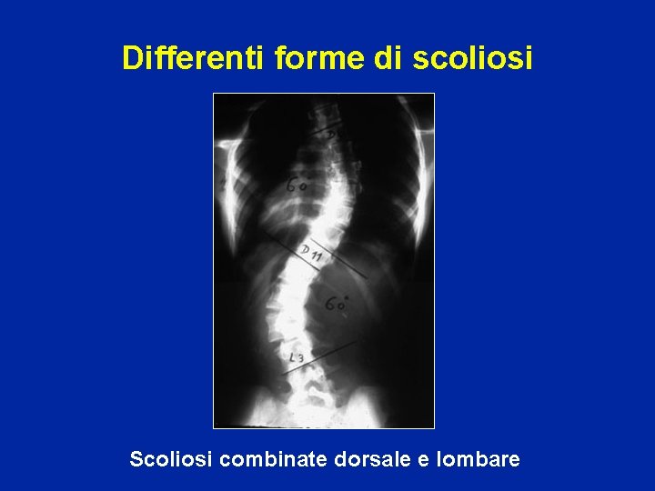 Differenti forme di scoliosi Scoliosi combinate dorsale e lombare 