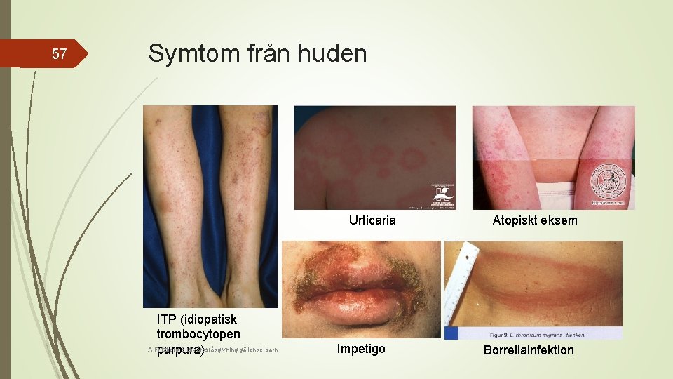 57 Symtom från huden Urticaria ITP (idiopatisk trombocytopen A Fritzberg Sjukvårdsrådgivning gällande barn purpura)