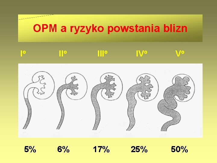 OPM a ryzyko powstania blizn Io 5% IIo IVo Vo 6% 17% 25% 50%