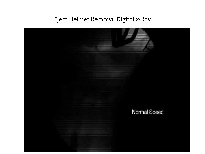 Eject Helmet Removal Digital x-Ray Eject Helmet Removal Digital x-Ray