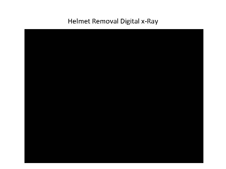 Helmet Removal Digital x-Ray Helmet Removal Digital x-Ray