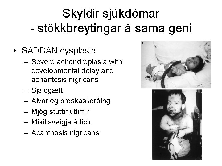 Skyldir sjúkdómar - stökkbreytingar á sama geni • SADDAN dysplasia – Severe achondroplasia with