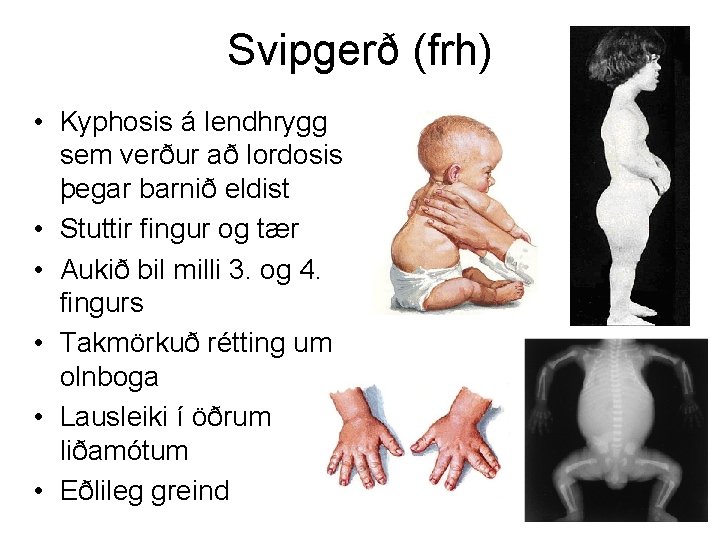 Svipgerð (frh) • Kyphosis á lendhrygg sem verður að lordosis þegar barnið eldist •