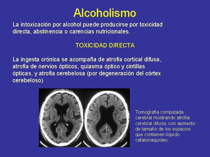 Alcoholismo La intoxicación por alcohol puede producirse por toxicidad directa, abstinencia o carencias nutricionales.