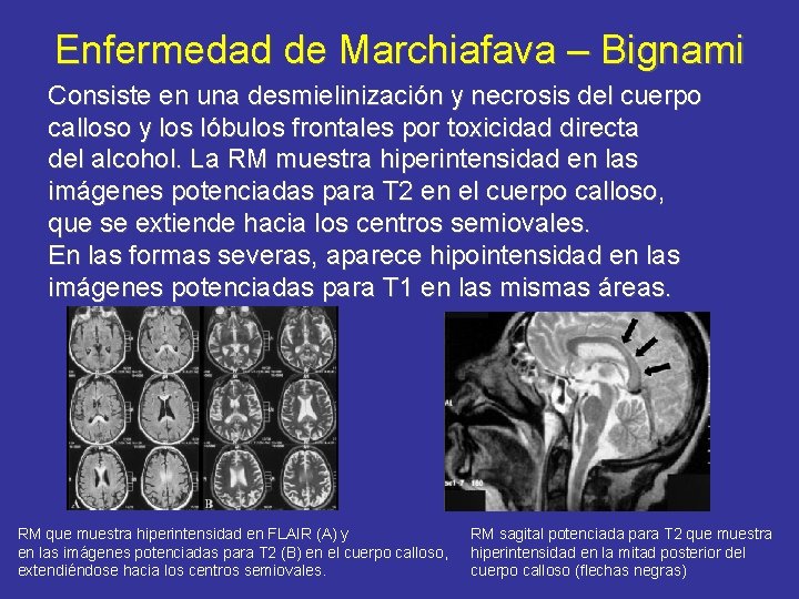 Enfermedad de Marchiafava – Bignami Consiste en una desmielinización y necrosis del cuerpo calloso