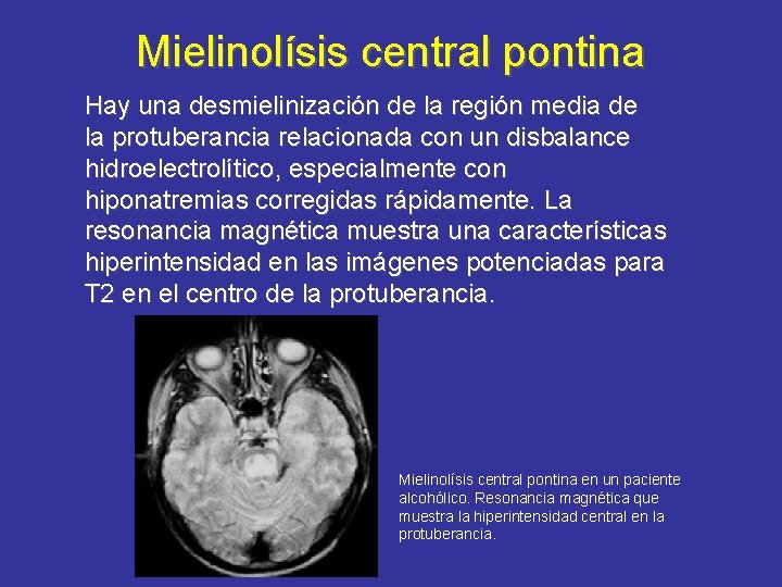 Mielinolísis central pontina Hay una desmielinización de la región media de la protuberancia relacionada