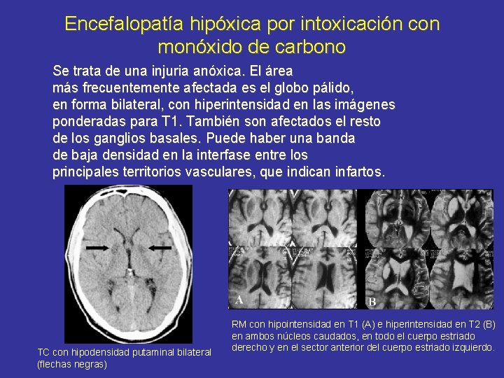 Encefalopatía hipóxica por intoxicación con monóxido de carbono Se trata de una injuria anóxica.