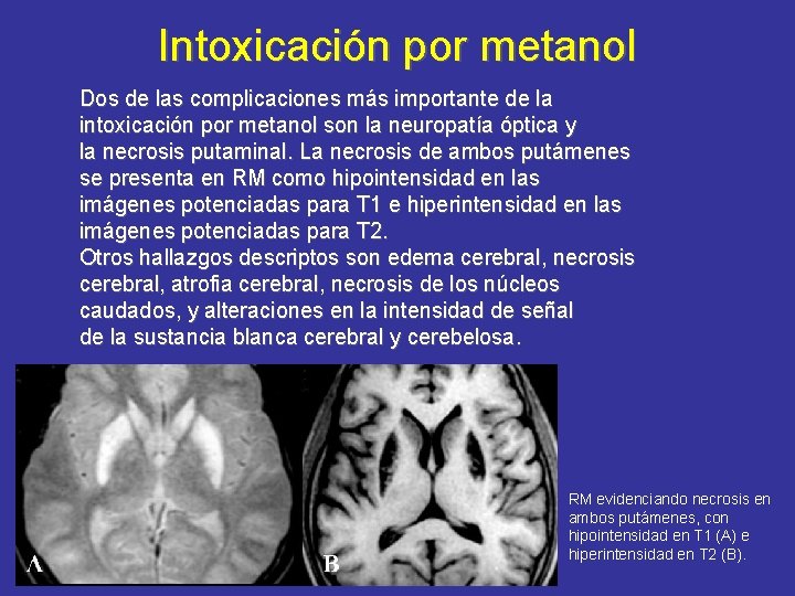 Intoxicación por metanol Dos de las complicaciones más importante de la intoxicación por metanol